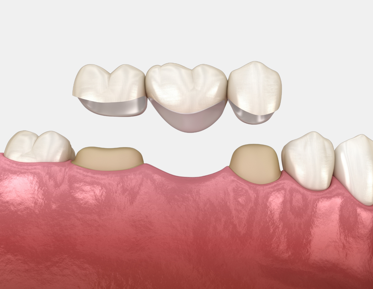 Dental bridges